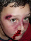 Special Effects: Portrait of boy taken from a slightly elevated position. Shows synthetic bruises around the nose (giving the appearance of the nose being broken), artificial blood apparently streaming from the right nostril, and a realistic synthetic cut on the right eyebrow. Casualty simulation of this nature is employed for both practical first aid training and in theatrical makeup. Television, theatre and the film industry use our techniques. For medical training Cool Faces can provide realistic artificial burns, cuts, grazes and other injuries, as required.