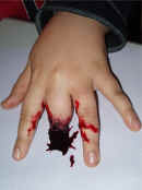 Special Effects: Plan view of boy's left hand with the index finger apparently severed at the middle knuckle. Synthetic blood appears to have spilled from the realistic wound and pooled on the surface upon which the hand rests. Casualty simulation of this nature is employed for both practical first aid training and in theatrical makeup. Television, theatre and the film industry use our techniques. For medical training Cool Faces can provide realistic artificial burns, cuts, grazes and other injuries, as required.
