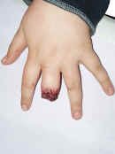 Special Effects: Plan view of boy's left hand with the index finger apparently severed at the middle knuckle. A small amount of synthetic blood appears to be congealed on the end of the stump. The overall visual effect is that of a cauterised realistic wound. Casualty simulation of this nature is employed for both practical first aid training and in theatrical makeup. Television, theatre and the film industry use our techniques. For medical training Cool Faces can provide realistic artificial burns, cuts, grazes and other injuries, as required.